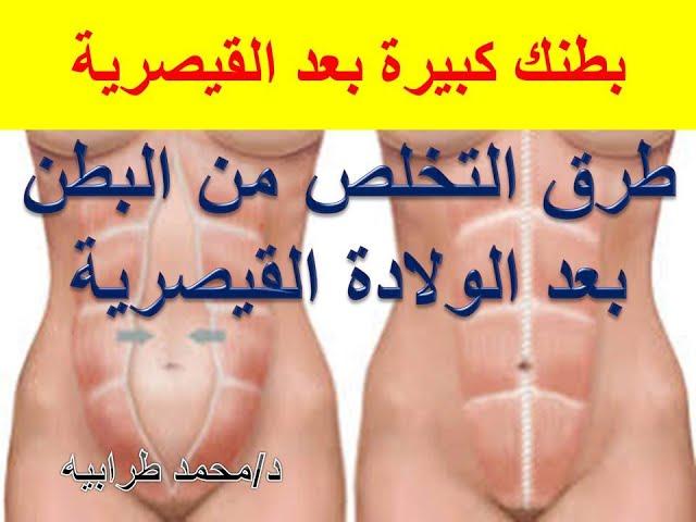 دليل شامل حول وسائل لإزالة البطن بعد الولادة: الأسباب والطريقة